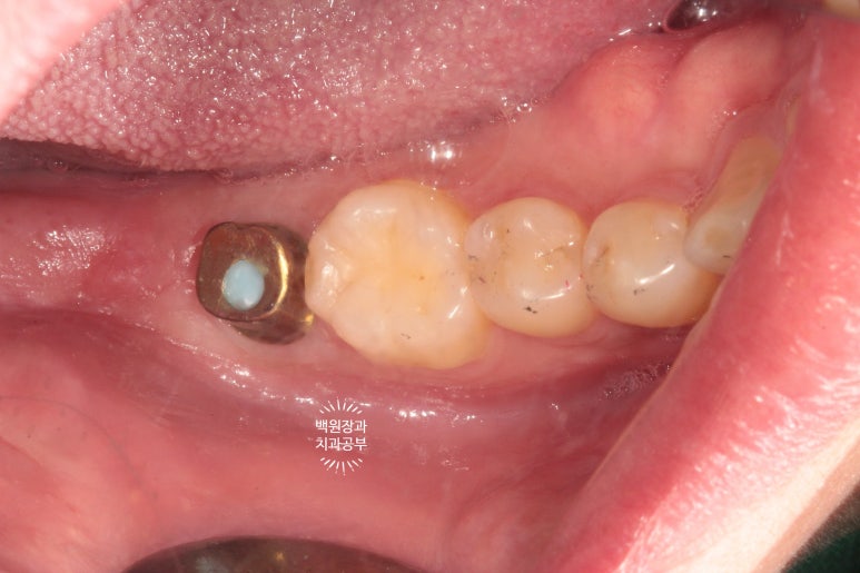 아래 어금니가 없어 위 어금니가 내려왔어요. 부분 교정을 곁들인 스트라우만 임플란트 수술. 억울한 신경치료를 피해보자. 치료과정/치료기간/비용/후기. 관련 이미지 9