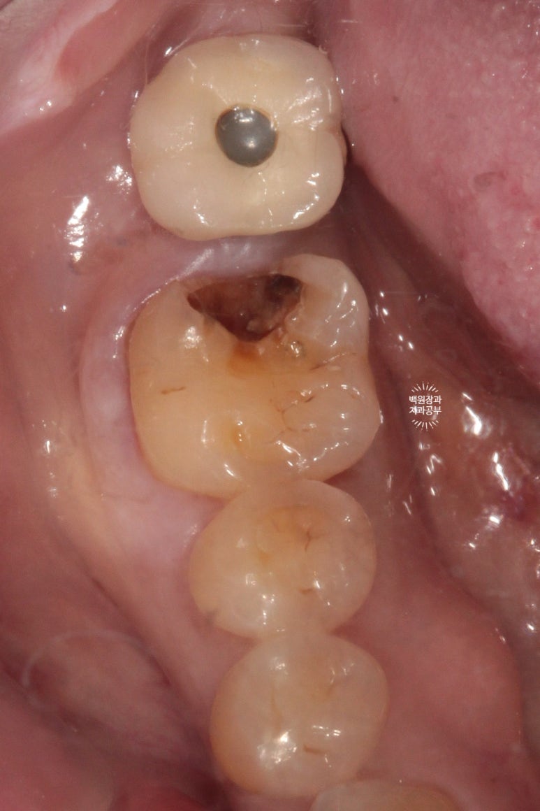 어금니 보철물이 떨어졌어요. 골드인레이 탈락 후 지르코니아 크라운으로 치료. 충치치료과정/치료기간/비용/후기. 관련 이미지 4