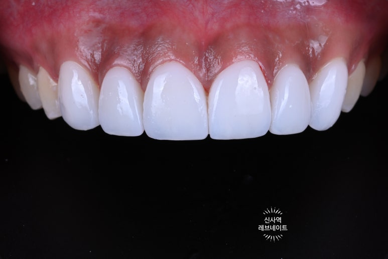 What About Laminates at Sinsa Station? Rev Dental Clinic’s Revnate. image 14