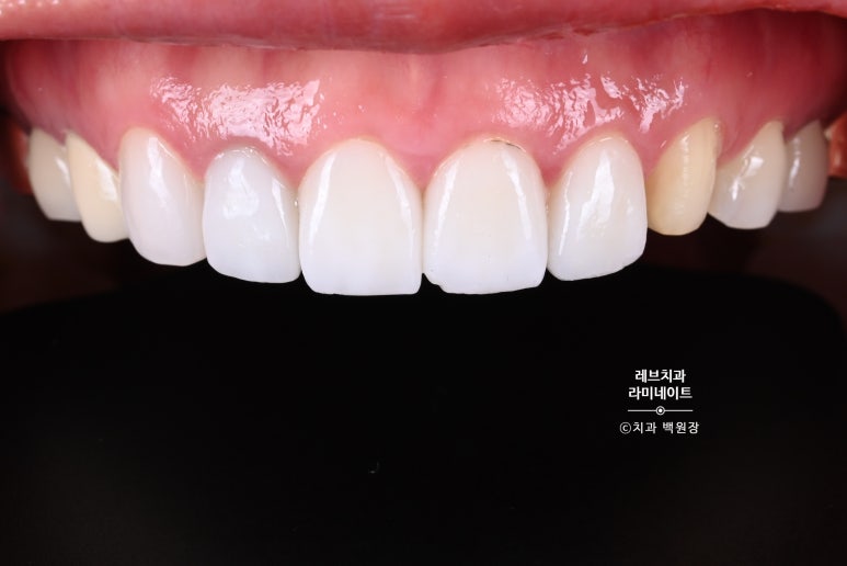 신사역 퍼스널컬러 맞춤 치과. 전담 세라미스트가 앞니 크라운과 라미네이트를 만들어 드립니다. 관련 이미지 5