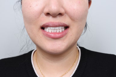 서울 신사역 [레브치과] 치아미백으로 해결 안되는 누렁니를, 하얗고 가지런한 앞니로 환한 미소를! 레브네이트 베이직 살펴보기. 관련 이미지 13