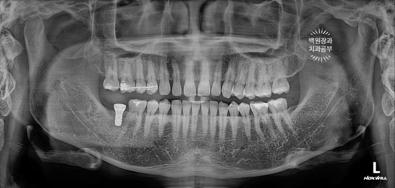 아래 어금니가 없어 위 어금니가 내려왔어요. 부분 교정을 곁들인 스트라우만 임플란트 수술. 억울한 신경치료를 피해보자. 치료과정/치료기간/비용/후기. 관련 이미지 7