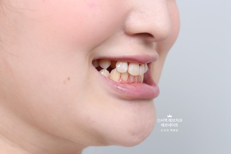 신사역 치과. 아나운서 면접 전 앞니 벌어진 공간을 라미네이트로만 해결할 수 있었던 사연.. 관련 이미지 10