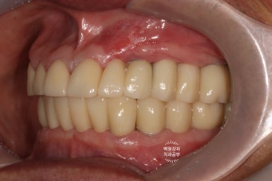 임플란트장인의 마음으로 8개월간 전체임플란트 완성. 치주과 전문의. 관련 이미지 30