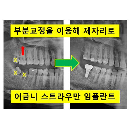 아래 어금니가 없어 위 어금니가 내려왔어요. 부분 교정을 곁들인 스트라우만 임플란트 수술. 억울한 신경치료를 피해보자. 치료과정/치료기간/비용/후기. 관련 이미지 1