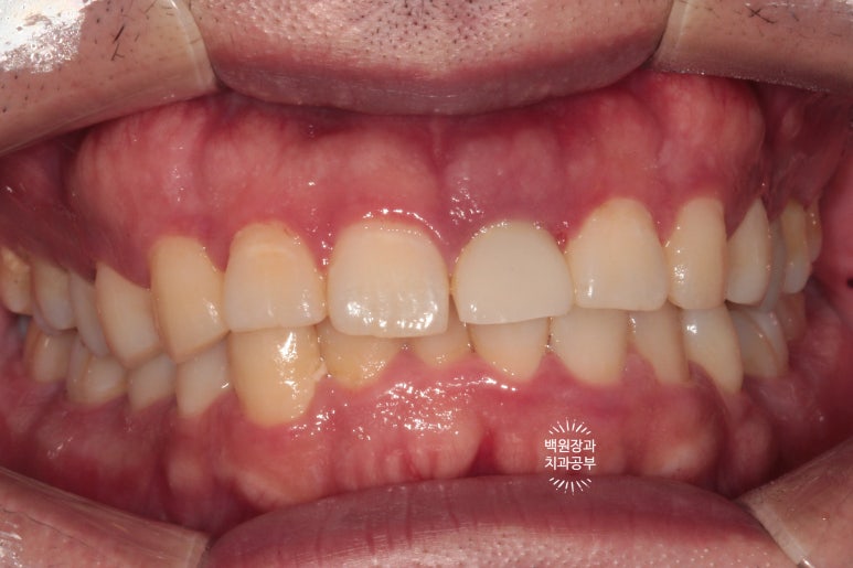 앞니 머리가 기둥째 부러졌어요. 발치 동시 뼈이식 오스템 BA 임플란트. 치료과정/치료기간/비용/후기. 압구정 치과. 관련 이미지 20