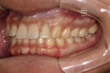 교정 유지장치 근처 앞니 옆면 충치 및 착색 간단히 3M 레진으로 치료. 치료과정/비용/후기. 과잉진료 없는 치과. 관련 이미지 13