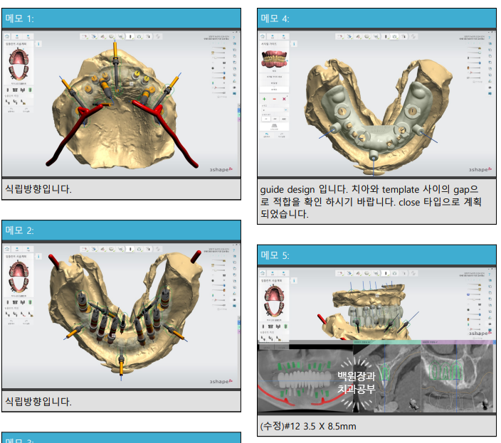 불편한 틀니를 아직도 쓰시나요? 전체 임플란트 치료비용/치료기간/치료과정. 관련 이미지 8
