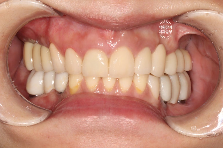 부분틀니 대신 어금니 임플란트를 만들어드립니다. 40대 어금니 상악동 뼈이식 임플란트. 치료기간/비용/과정. 관련 이미지 22