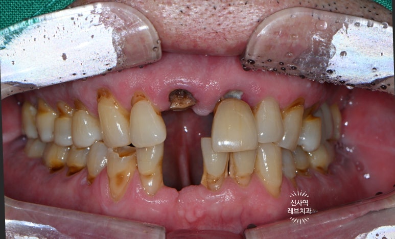 신사역 앞니 임플란트 잘하는 레브치과. 가격/비용/사진/후기. (프로포폴 수면가능) 관련 이미지 2