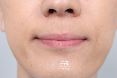 레브네이트 엑스퍼트 ; 유튜버가 선택한 앞니 라미네이트. 앞니 레진 벌어짐을 자연스러우면서 화사하게 바꿔봅시다. 신사역 치과. 치료후기/비용/가격. 관련 이미지 9