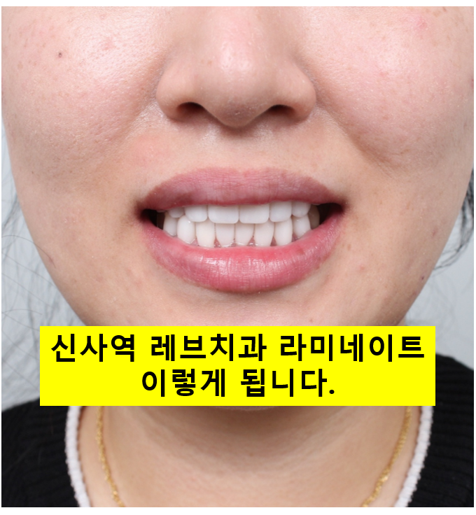 서울 신사역 [레브치과] 치아미백으로 해결 안되는 누렁니를, 하얗고 가지런한 앞니로 환한 미소를! 레브네이트 베이직 살펴보기. 관련 이미지 1