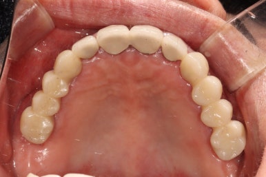 어금니 여러개가 없어요. 전체 임플란트와 앞니 크라운을 통한 완벽한 재건!! 치료과정/치료기간/비용/후기. 관련 이미지 30