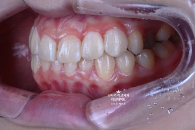 신사역 치과. 아나운서 면접 전 앞니 벌어진 공간을 라미네이트로만 해결할 수 있었던 사연.. 관련 이미지 27