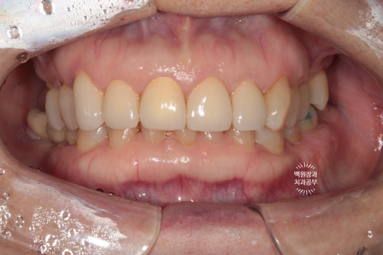 삐뚤빼뚤 앞니 세로 금  - 신경치료 없이 지르코니아 크라운으로. 상악동뼈이식술 임플란트. 관련 이미지 11