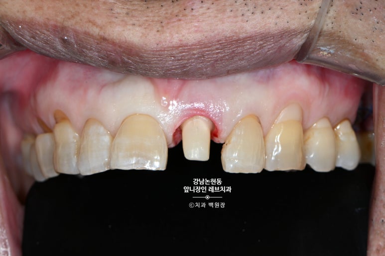 강남논현동치과 60대 치아부러짐 - 신경치료하고 기둥심고 앞니 크라운 잘하는곳! 가격/과정/후기/부작용. 관련 이미지 11