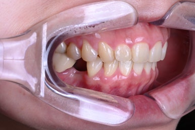 신사역 라미네이트. 결혼식 전 앞니 고민, 얇은 세라믹 레브네이트로 해결! 관련 이미지 4