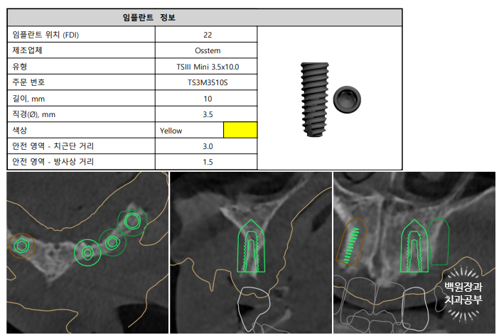 만성치주염으로 인해 아주 좁아진 잇몸뼈에 광범위한 뼈이식 + 전체임플란트. 신사 레브치과. 관련 이미지 16