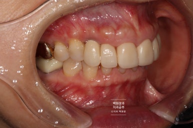 크라운 앞니 충치로 냄새가 나요 - 최소한의 임플란트와 씌우는 치료. 치료과정/기간/비용. 관련 이미지 15
