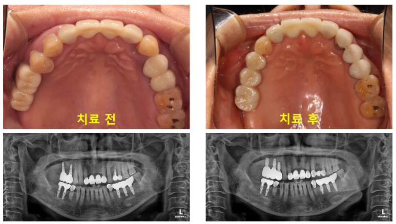 임플란트 주위염이 심하면? 임플란트 재수술을 잘하는 치과에 방문해보세요. 관련 이미지 23