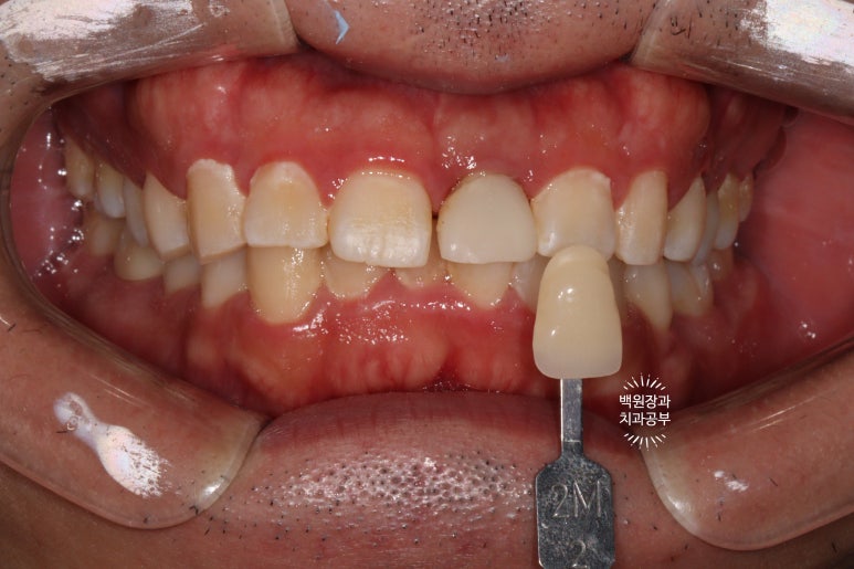 앞니 머리가 기둥째 부러졌어요. 발치 동시 뼈이식 오스템 BA 임플란트. 치료과정/치료기간/비용/후기. 압구정 치과. 관련 이미지 21