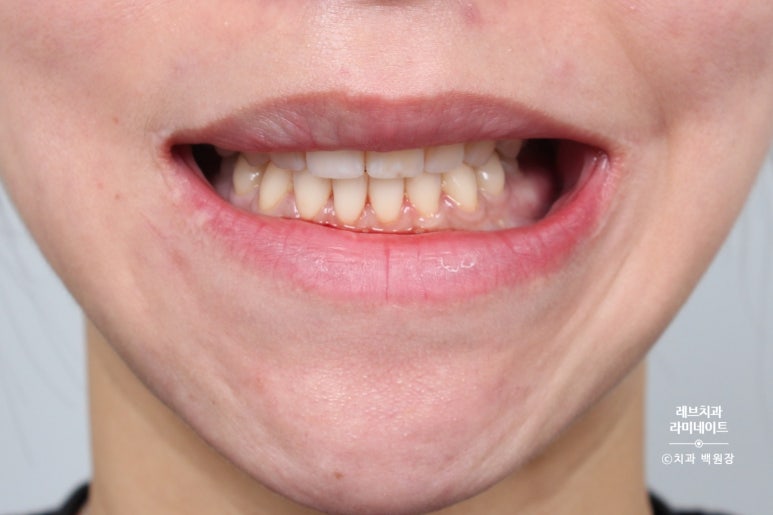레브네이트 베이직. 치아미백과 치아교정을 한번에! 치아삭제 사진 있음. 신사역 치과 앞니라미네이트 모델/비용/후기. 관련 이미지 11