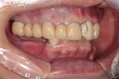 어금니 여러개가 없어요. 전체 임플란트와 앞니 크라운을 통한 완벽한 재건!! 치료과정/치료기간/비용/후기. 관련 이미지 3