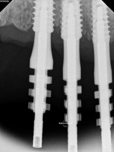 오스템임플란트 네비게이션 전체 임플란트 치료일기. 치료과정/치료기간/비용/솔직후기. 관련 이미지 12