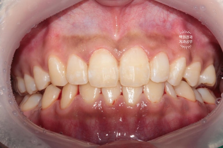 잇몸치료와 앞니 레진치료. 3년이 지난 모습 궁금하지 않으신가요? 3M 레진쓰는 치과. 후기/시간/과정/비용. 관련 이미지 8