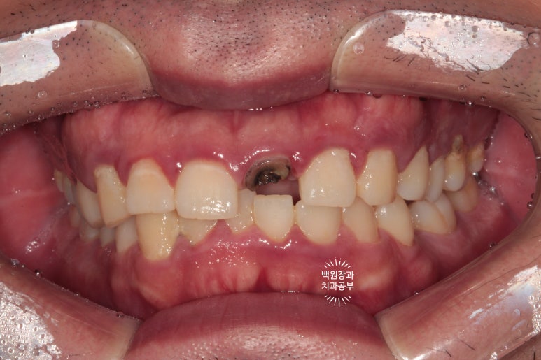 앞니 머리가 기둥째 부러졌어요. 발치 동시 뼈이식 오스템 BA 임플란트. 치료과정/치료기간/비용/후기. 압구정 치과. 관련 이미지 2