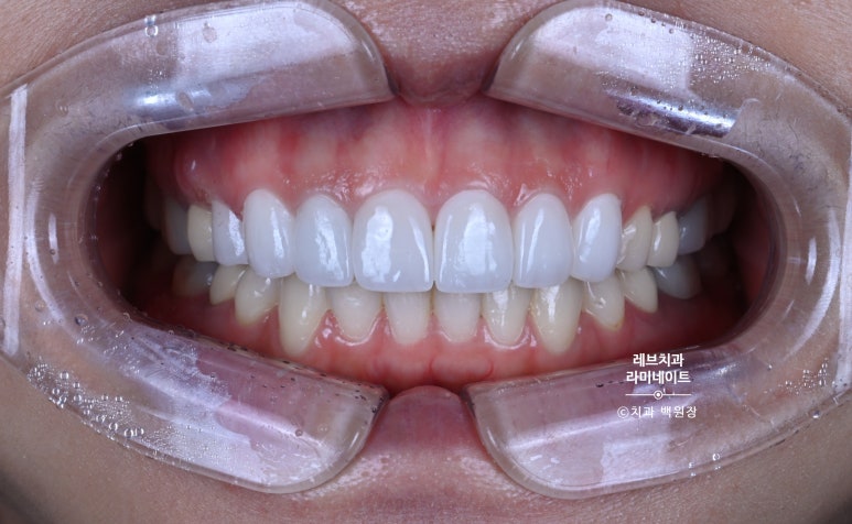 신사역 퍼스널컬러 맞춤 치과. 전담 세라미스트가 앞니 크라운과 라미네이트를 만들어 드립니다. 관련 이미지 11