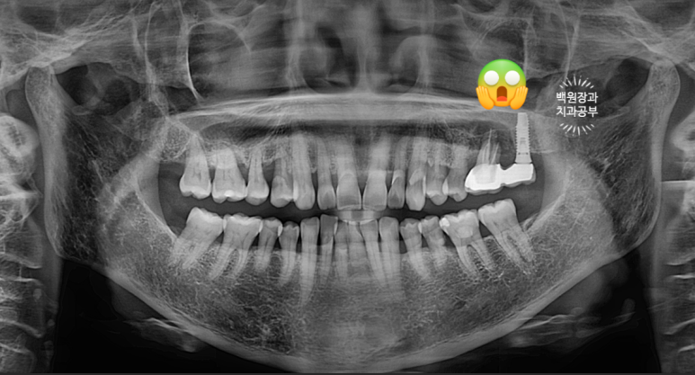 치아와 임플란트를 연결하면 치아가 망가집니다. 발치 동시 치조골 이식 후 임플란트. 치료과정/치료기간/비용/후기. 관련 이미지 6