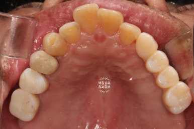 아래 어금니 임플란트 6개면 틀니를 안써도 됩니다.  치주염 전문 착한치과. 치료기간/임시치아과정/후기/비용. 관련 이미지 19
