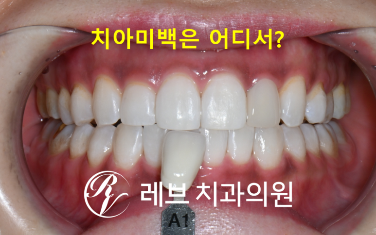 앞니치아미백 비용 들인만큼 잘되는 치과 찾는법. 신사역 치과 미백 성지. 관련 이미지 1