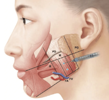 이갈이 보톡스, 신사역 치과 의사가 설명히는 효과, 주기, 통증,가격 총정리 관련 이미지 2