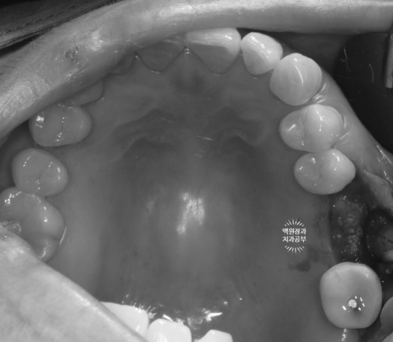 치아와 임플란트를 연결하면 치아가 망가집니다. 발치 동시 치조골 이식 후 임플란트. 치료과정/치료기간/비용/후기. 관련 이미지 13