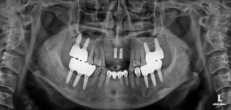 앞니가 풍치로 흔들거려요. 심한 치주염인데 임플란트 가능할까요? 치료과정/치료기간/비용/성공후기. 신금호역 치과 추천. 관련 이미지 21