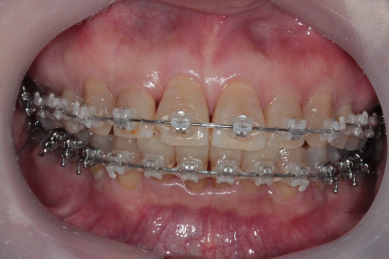 삐뚤어진 앞니를 8개월만에 가지런하게 만드는 50대 성인부분교정. 신사역 교정치과. 치료과정/기간/비용. 관련 이미지 15
