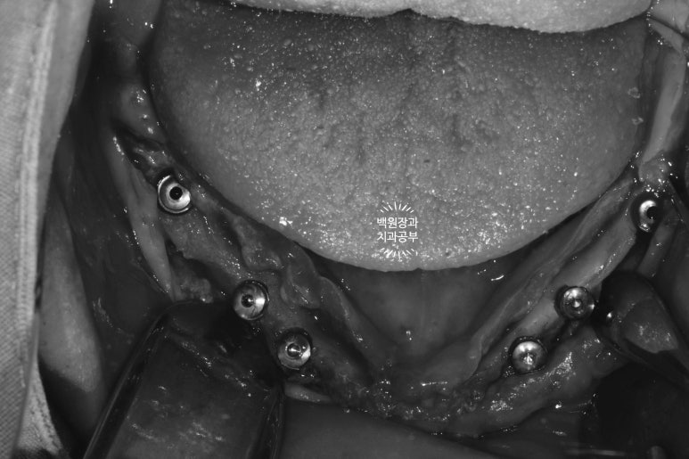 만성치주염으로 인해 아주 좁아진 잇몸뼈에 광범위한 뼈이식 + 전체임플란트. 신사 레브치과. 관련 이미지 34