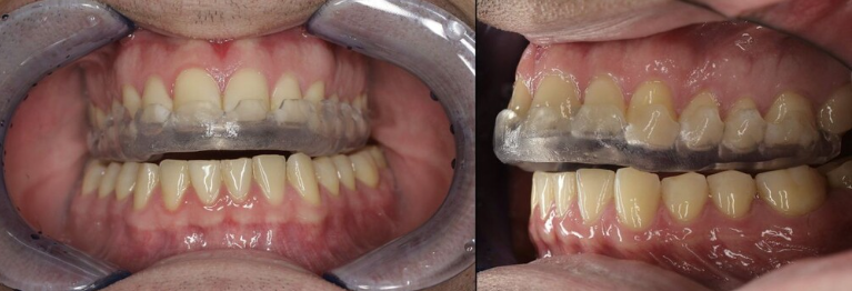 신사역 치과 - 이갈이와 이악물기의 치료. 좋은 보톡스와 이갈이 스플린트. 코어톡스 가격/주기/효과. 관련 이미지 8