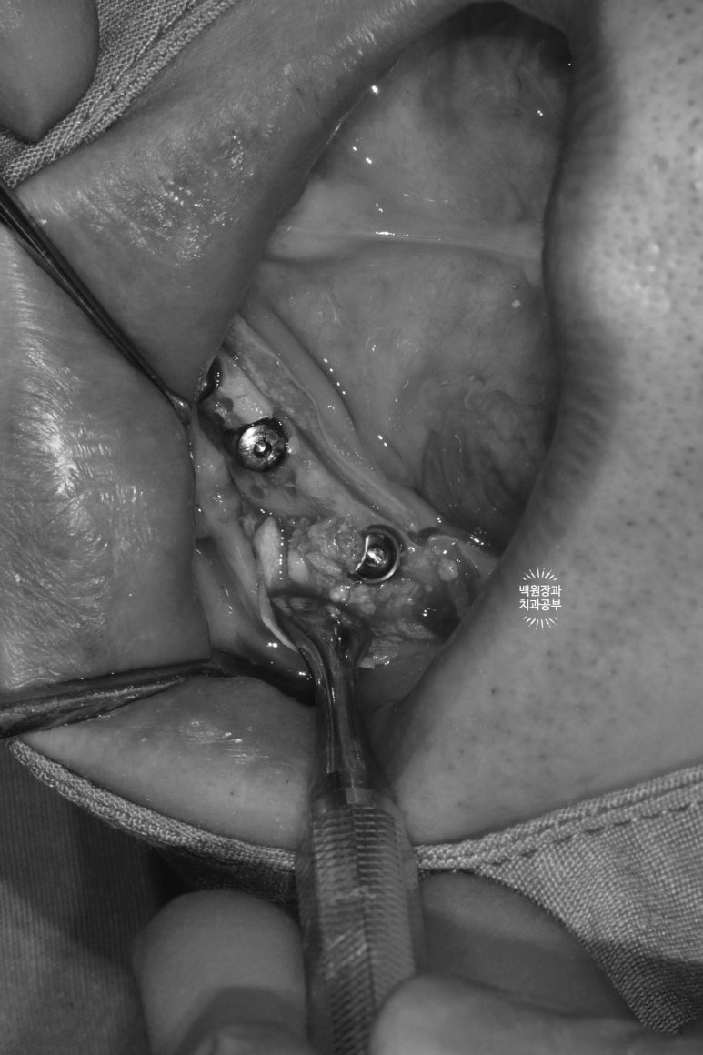 만성치주염으로 인해 아주 좁아진 잇몸뼈에 광범위한 뼈이식 + 전체임플란트. 신사 레브치과. 관련 이미지 35