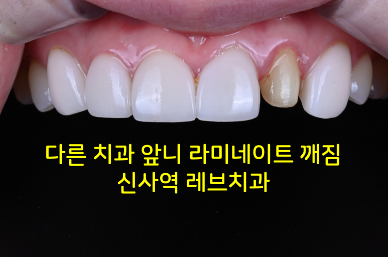 신사역 다른치과 앞니 라미네이트 하나 깨짐. 재치료 잘하는 레브치과의 레브네이트로 해결!! 관련 이미지 1