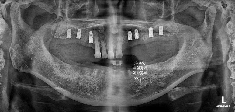임플란트장인의 마음으로 8개월간 전체임플란트 완성. 치주과 전문의. 관련 이미지 15