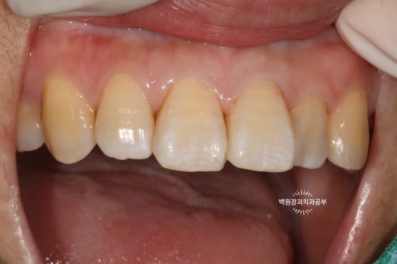 앞니레진치료 할 줄 모르는 치과의사는 없지만, 좋은 레진으로 치료하는 치과의사는 잘 없습니다. 관련 이미지 26