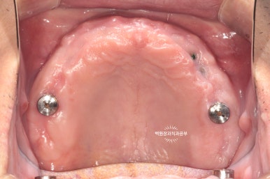 오스템임플란트 네비게이션 전체 임플란트 치료일기. 치료과정/치료기간/비용/솔직후기. 관련 이미지 8