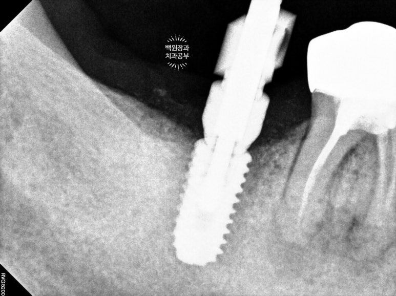 신경치료한 치아 부러짐! 뼈이식 하면서 임플란트 수술하는 과정/기간/비용. 관련 이미지 14
