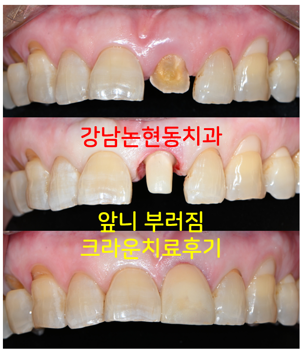 강남논현동치과 60대 치아부러짐 - 신경치료하고 기둥심고 앞니 크라운 잘하는곳! 가격/과정/후기/부작용. 관련 이미지 1