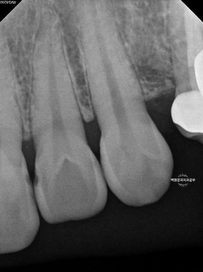앞니레진치료 할 줄 모르는 치과의사는 없지만, 좋은 레진으로 치료하는 치과의사는 잘 없습니다. 관련 이미지 19