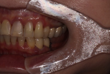 어금니 임플란트 주변 잇몸이식수술 - 저는 해야한다고 생각합니다. (feat. 대한치과의사협회 논문 + 치주과전문) 관련 이미지 7