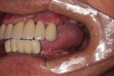 잇몸 염증 고름이 심했던 부위 - 만성치주염 진단하고 임플란트로 깔끔하게 치료! 신사역 치과 관련 이미지 11